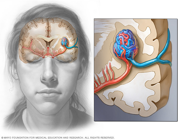 Brain AVM (arteriovenous malformation)